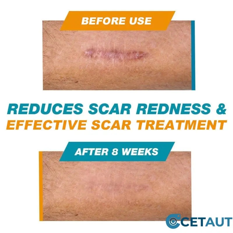 Silicone Scar Healing Stick cetaut
